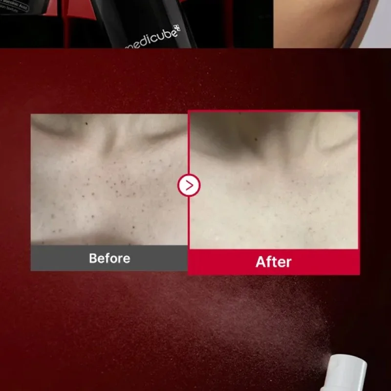 medicube RED ACNE BODY PEELING SHOT